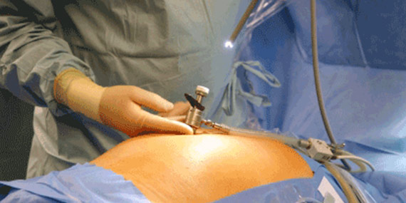 laparoskopie